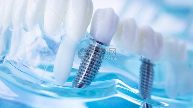 2025年，老年人拔牙价格如何？揭秘价格背后的因素**
